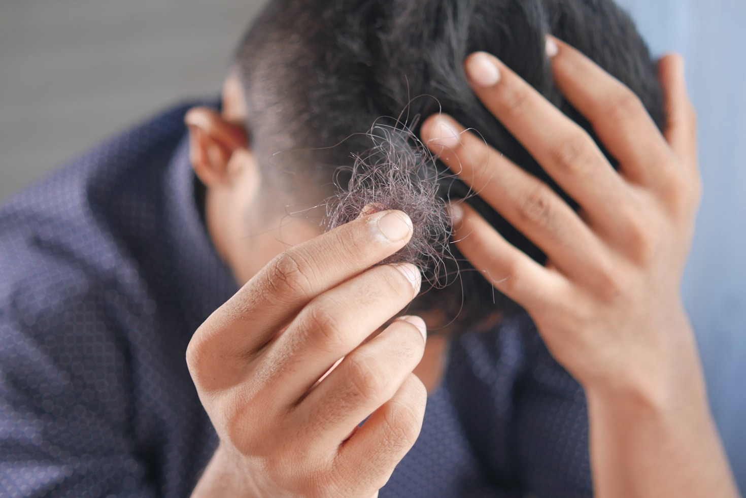 Understanding Hair Loss: A Comprehensive Guide